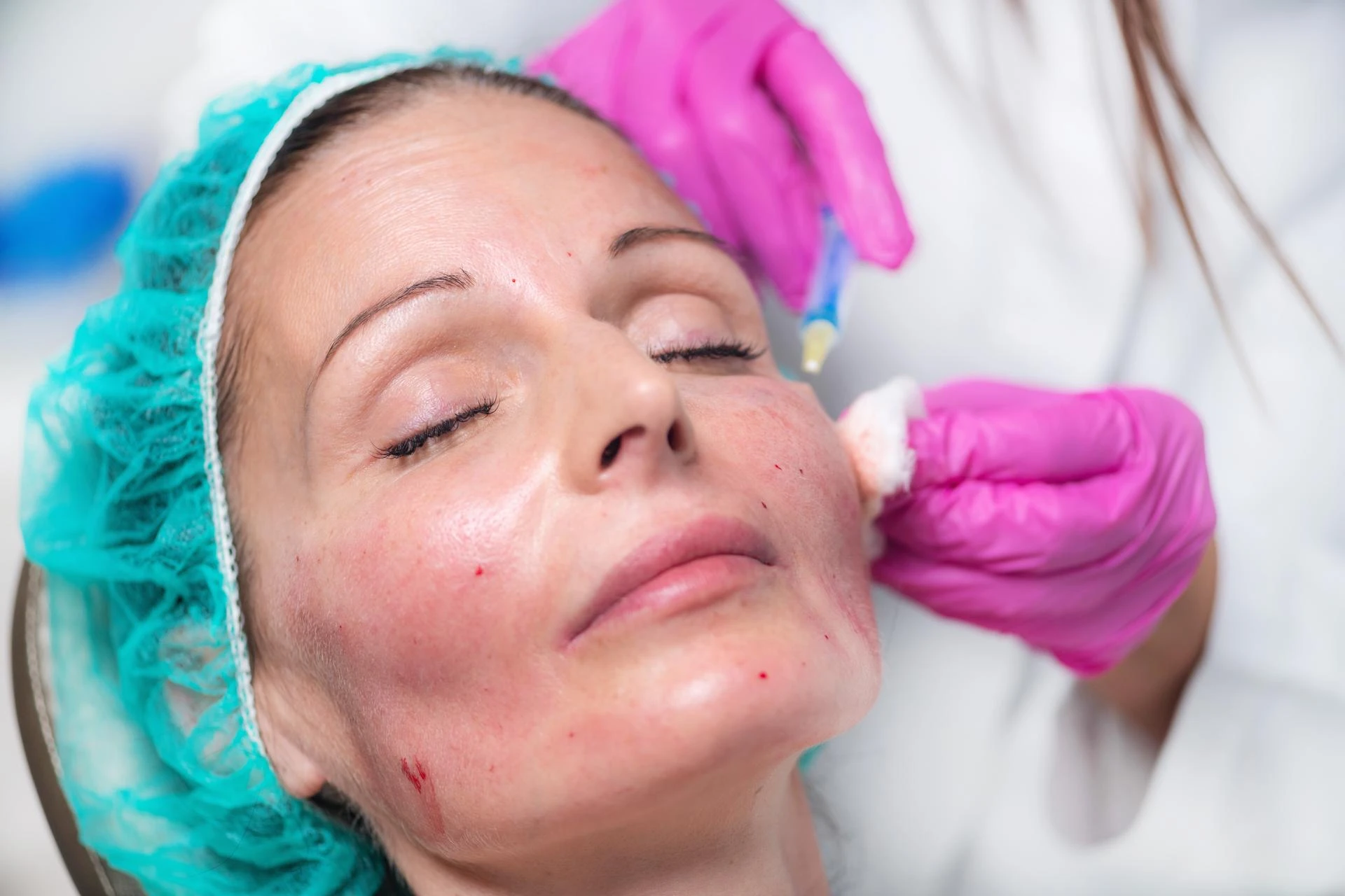 Microneedling