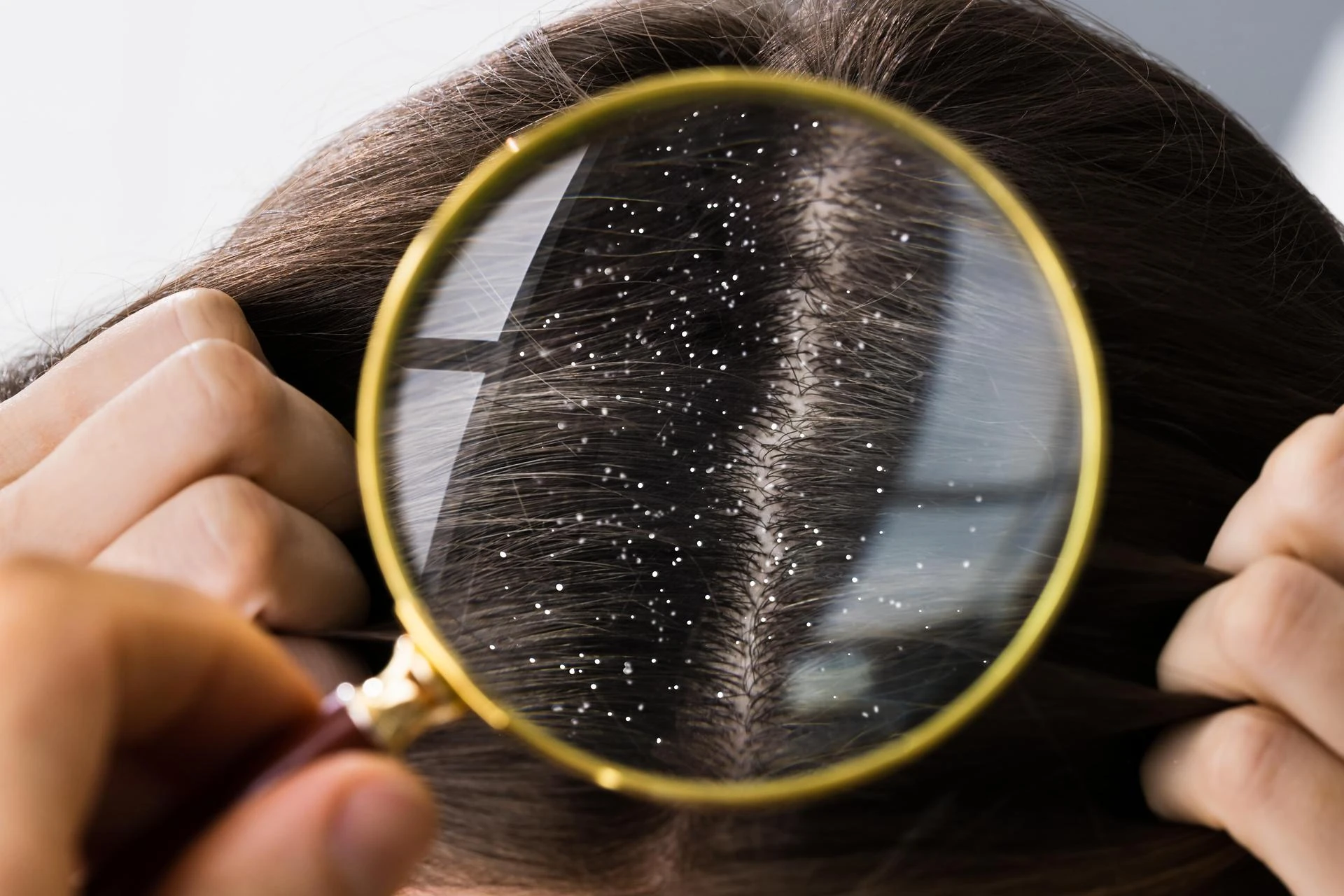 Dandruff & Scalp Disorders