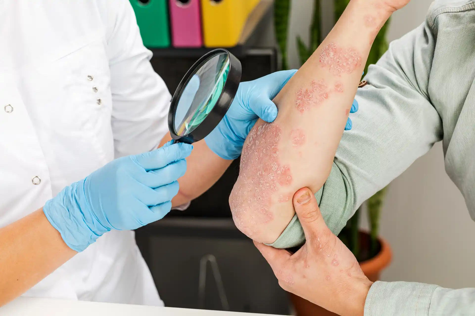 Psoriasis Treatment