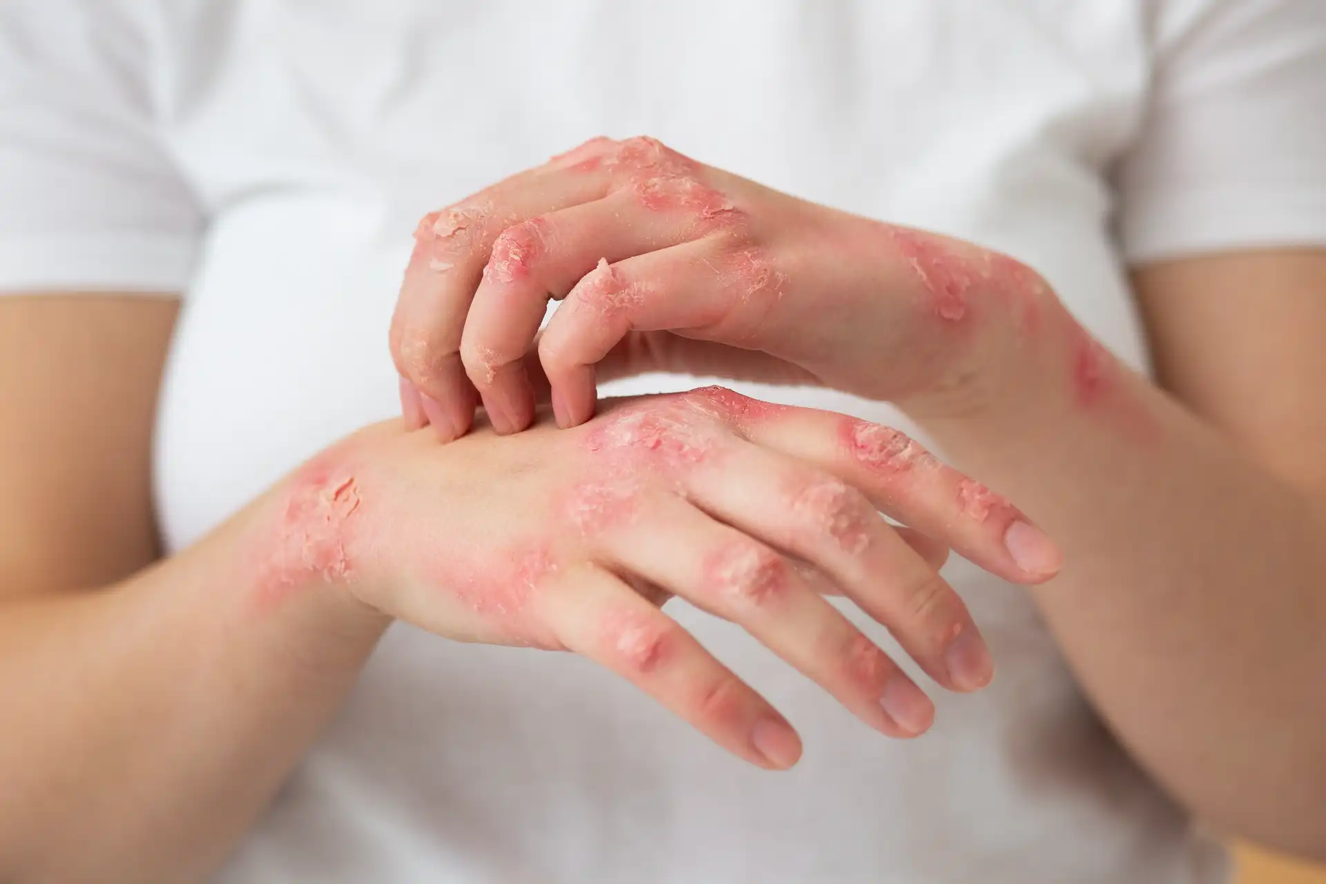 Eczema Treatment
