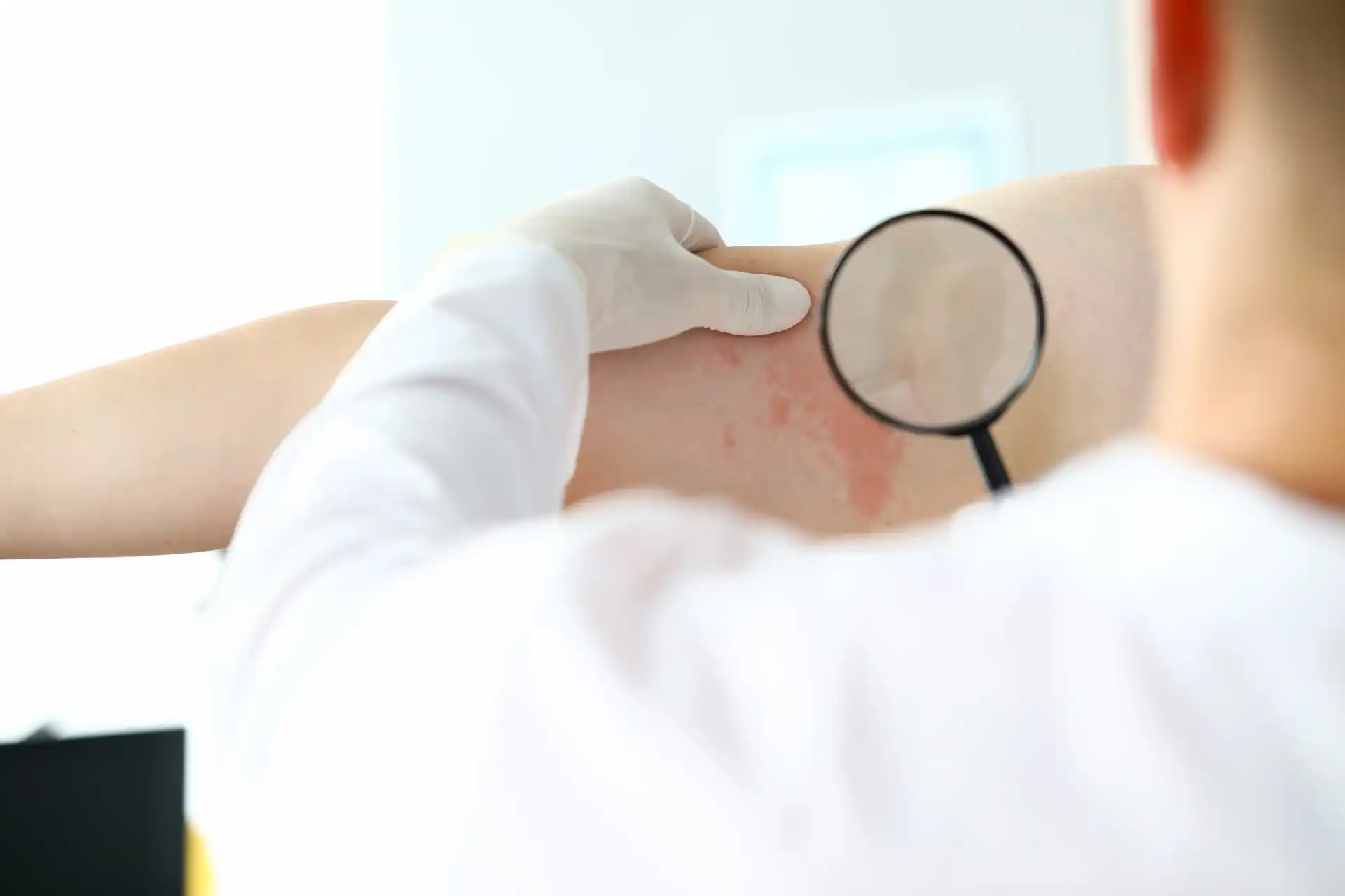 Atopic Dermatitis Treatment