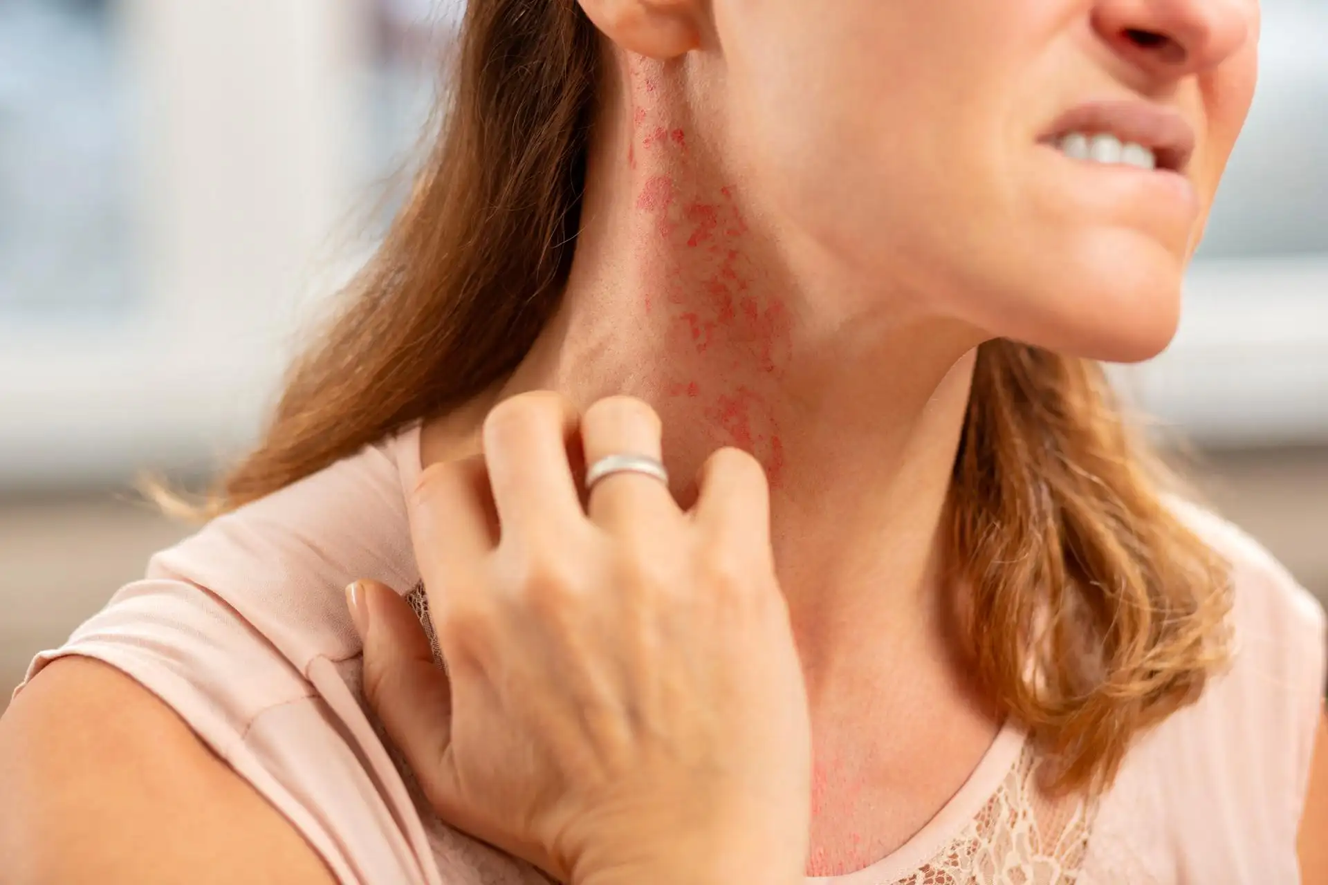 Autoimmune Skin Disorders